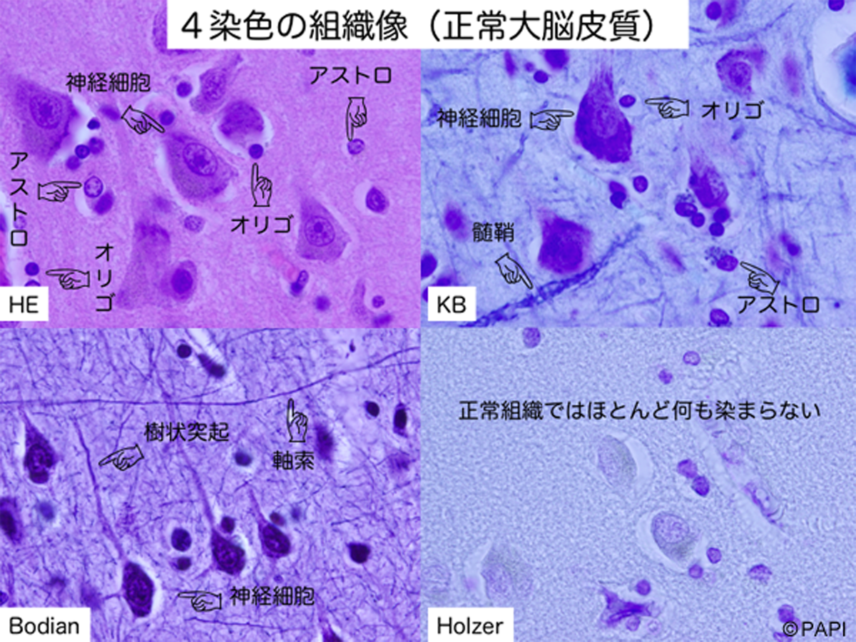 脳の細胞病理