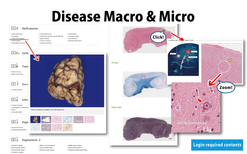 Disease Macro & Micro