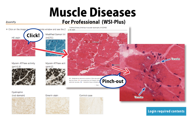 Muscle Diseases