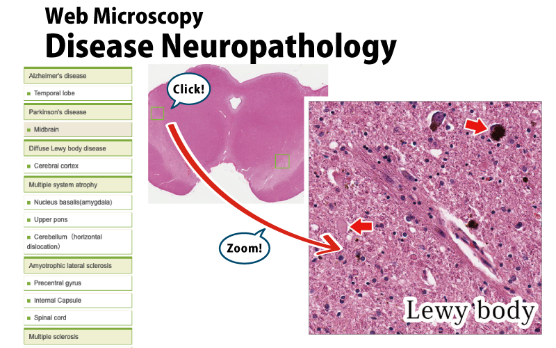 Disease Neuropathology