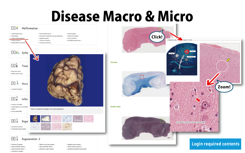 Disease Macro & Micro