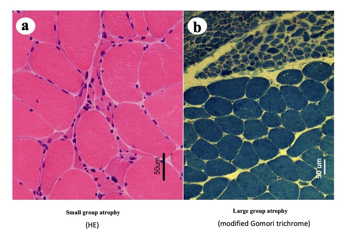 muscle atrophy histology