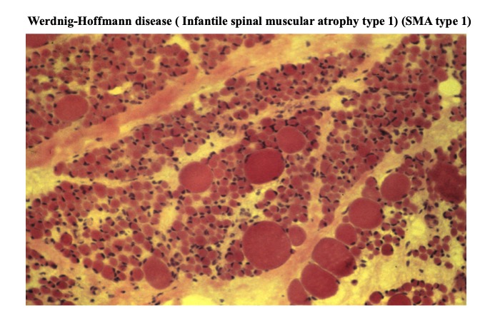 muscle atrophy histology