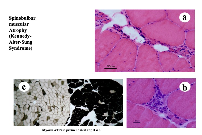 muscle atrophy histology