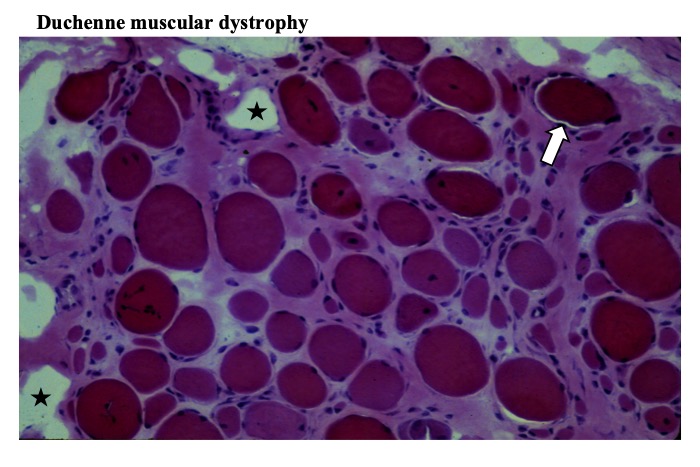 muscle atrophy histology