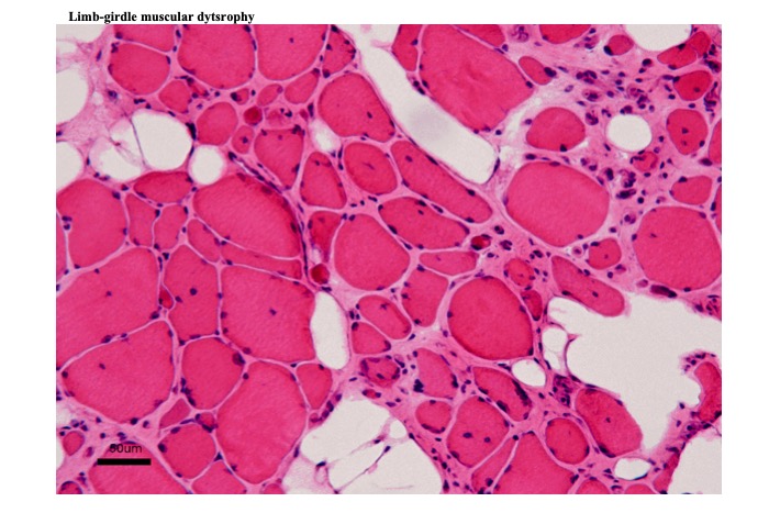 Limb-Girdle Muscular Dystrophy (LGMD) - Diseases