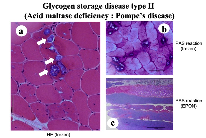 Muscle pain in glycogen storage disease