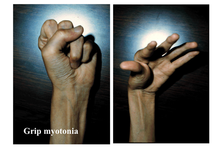 スタチン誘発性ミオパチーから回復できますか?